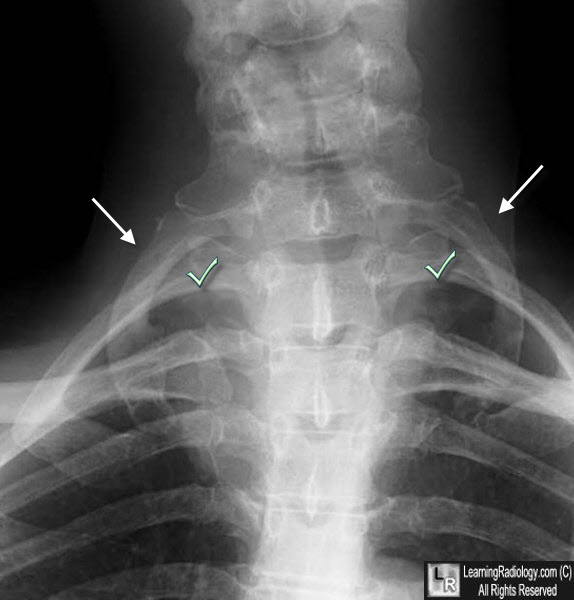 cervical rib